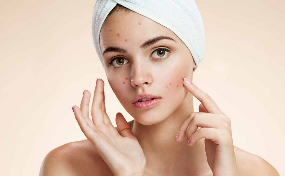 Get Permanent Solution For Your Acne Prone Skin